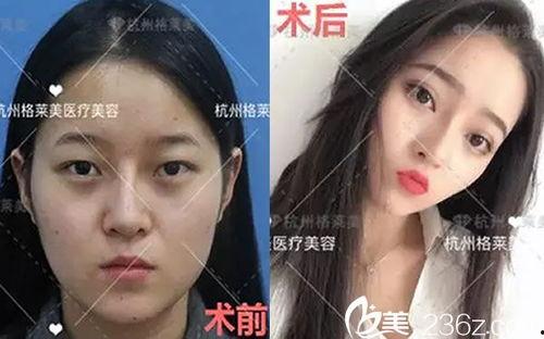 杭州整容爆料案件最新情况,真相逐步浮出水面 第1张 杭州整容爆料案件最新情况,真相逐步浮出水面 第1张